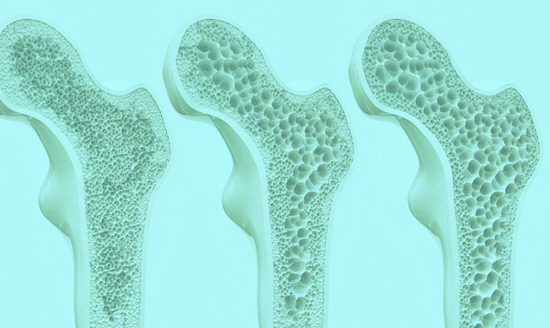 Osteoporose En Fractuurpreventie De Multidisciplinaire Richtlijn