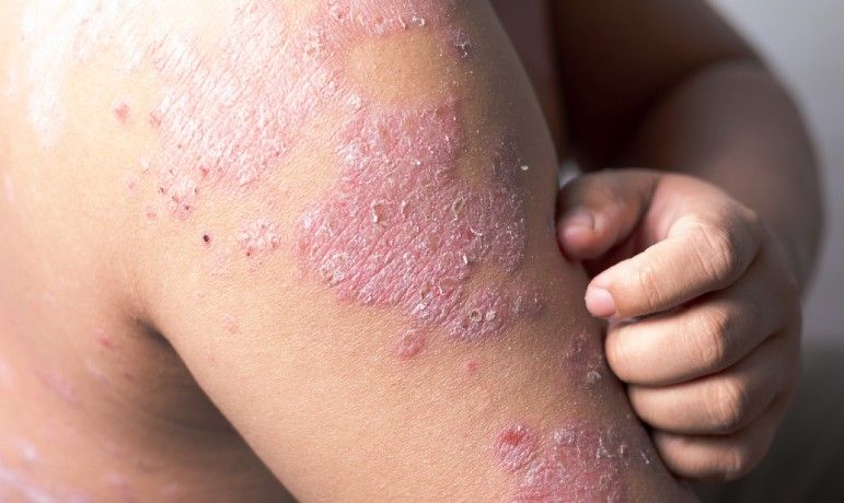 Revised Psoriasis Standard: Clearer Place for Peeling Agents