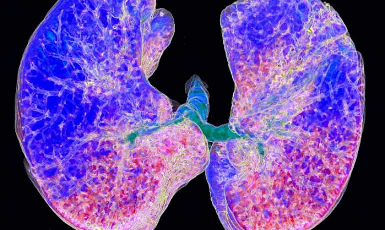 3 identified clusters of pulmonary fibrosis patients | MedNet